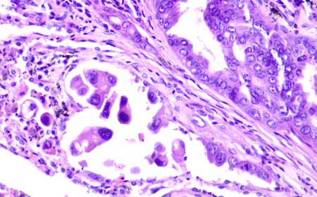 تحقیقات مرتبط با سرطان
